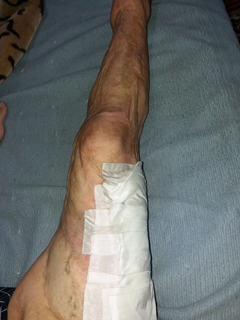 Chinul continuă pentru tânăra cu piciorul infectat. Nu a găsit niciun medic dispus să o opereze